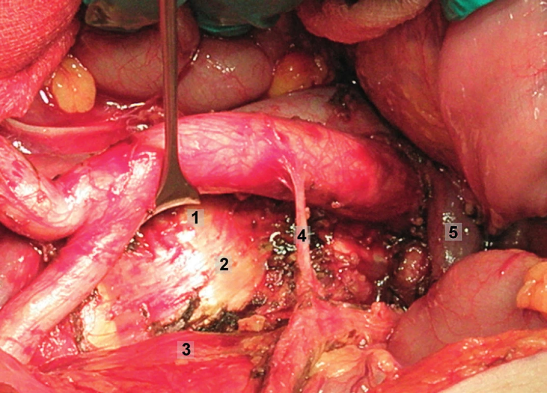 Systematická transperitoneální paraaortální lymfadenektomie – šestý krok; preaortální uzliny byly odstraněny, levé ovariální cévy a levý ureter odtaženy laterálně, aorta mediálně. Vypreparován prostor kolem a. mesenterica inferior a následně byly exstirpovány uzliny paraaortální a retroaortální. 1 – retroaortální oblast, 2 – paraaortální oblast, 3 – levý ureter, 4 – a. mesenterica inferior, 5 – levá renální véna