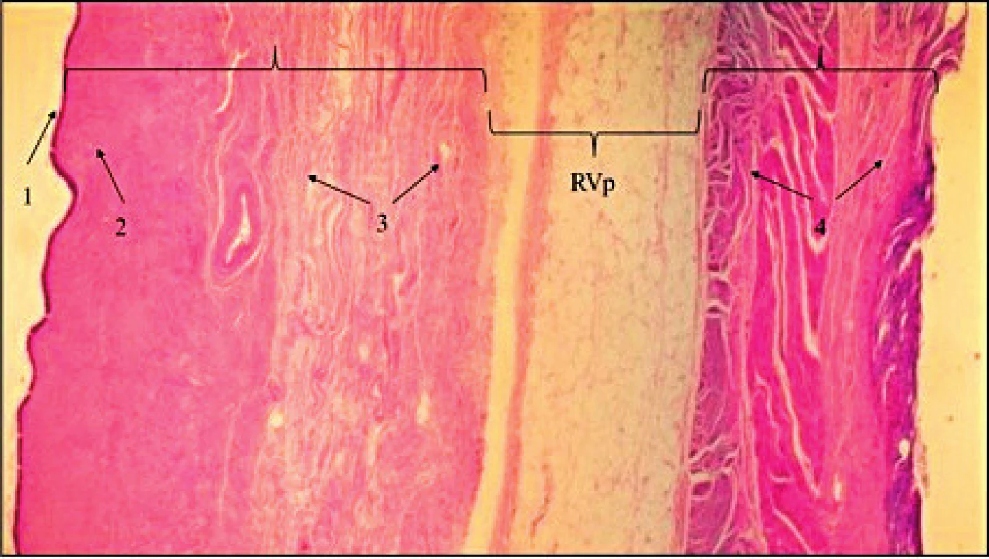Demonstrace avaskulárního rektovaginálního prostoru (RVp) z resekátu zadní poševní stěny a stěny rekta (hematoxilin eozin)