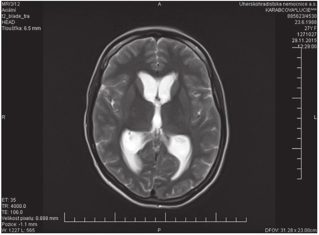 Na transverzálním T2 váženému snímku je patrné mírné rozšíření 3. mozkové komory i obou postranních komor v rámci obstrukčního hydrocefalu