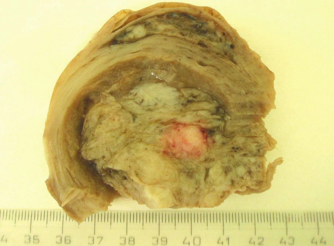 Intramurálne uložený tumor s nehomogennou štruktúrou na reze