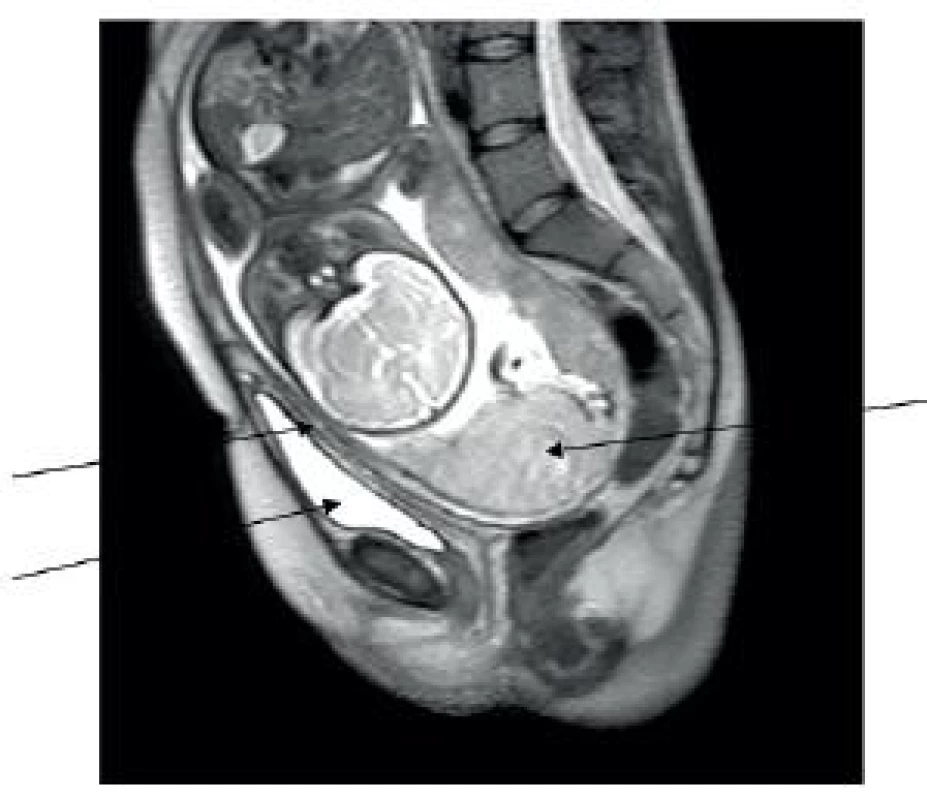 Snímek z vyšetření NMR, šipkami je označeno směrem zleva doprava vytažené děložní hrdlo, vytažený kraniální pól močového měchýře, placenta inzerující v děložním fundu