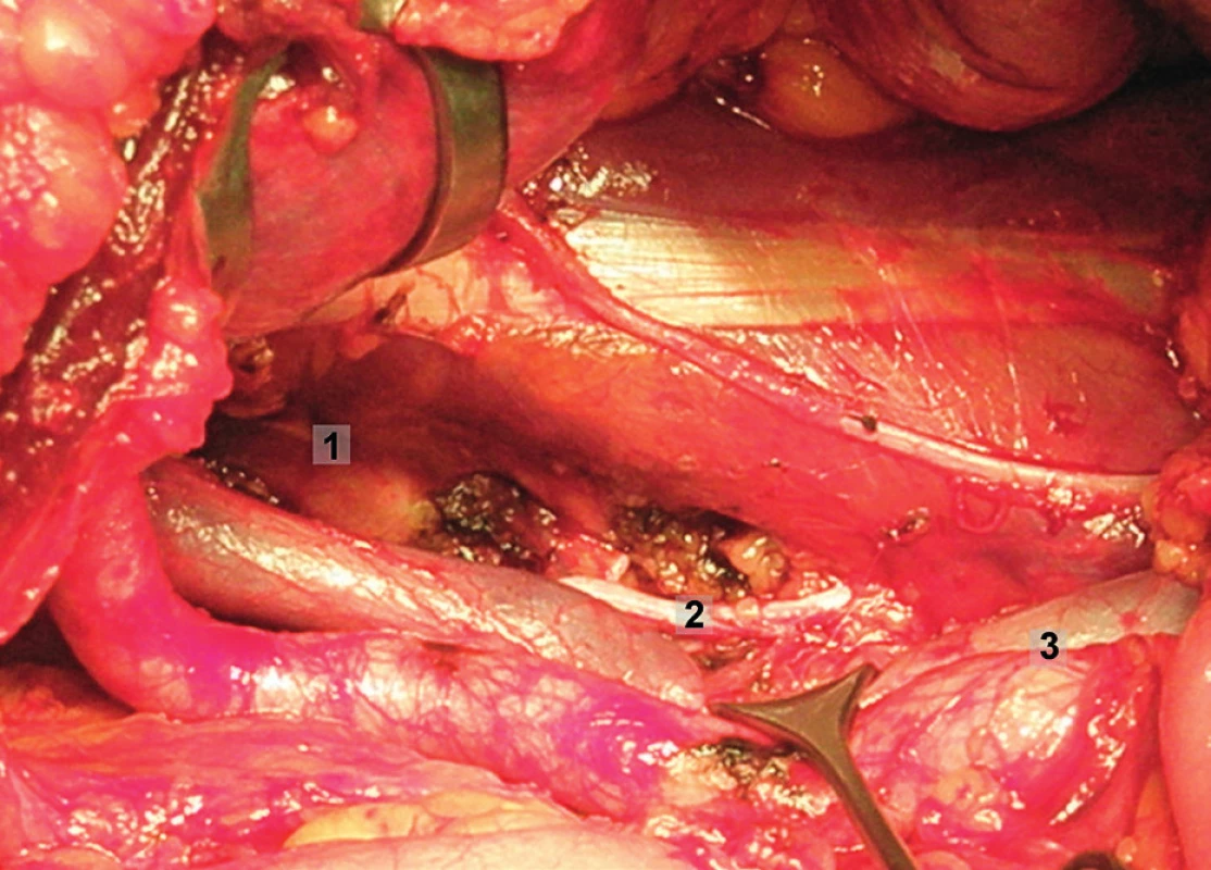 Systematická transperitoneální pánevní lymfadenektomie (pravá pánevní stěna) – šestý krok; odstraněn zbytek lymfatických uzlin z oblasti infraobturatorní a z oblasti společných ilických cév. Zevní a společné ilické cévy odsunuty mediálně a m. psoas laterálně. 1 – laterální ohraničení obturatorní fosy, 2 – obturatorní nerv, 3 – společné ilické cévy