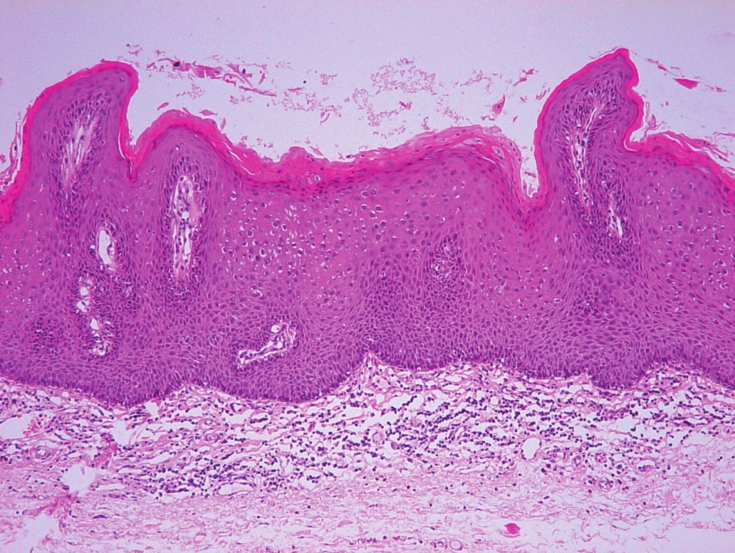 Histologický obraz vulvární LSIL – plochý kondylom (barvení hematoxylin-eozin, zvětšení 100)