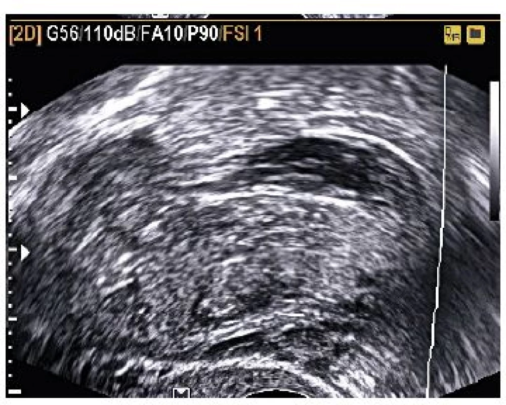 Nehomogenní masa 57,45×23,12 mm v blízkosti pravého ovaria, která nejeví souhyb 
s ovariem – susp. graviditas extrauterina l.dx