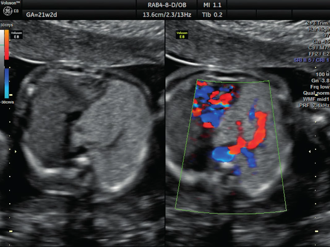 Ultrazvukové vyšetření ve 21. týdnu těhotenství – dopplerovské zobrazení přívodné cévy
Zobrazení aberantní systémové přívodné cévy vyživující sekvestr