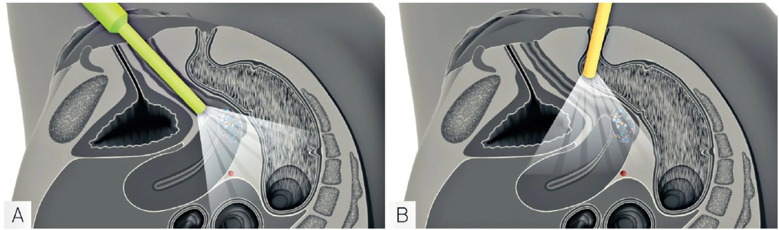 Ultrazvukové vyšetření lokálního rozsahu zhoubného nádoru děložního hrdla (vyšetření endoluminální sondou)