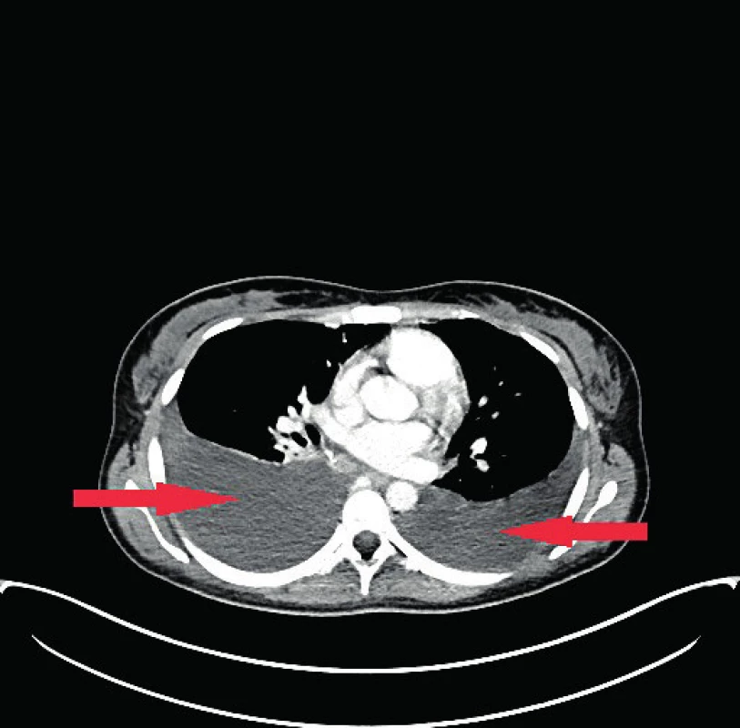 CT plic, šipky ukazují oboustranný fluidotorax (vpravo do 70 mm, vlevo do 44 mm)