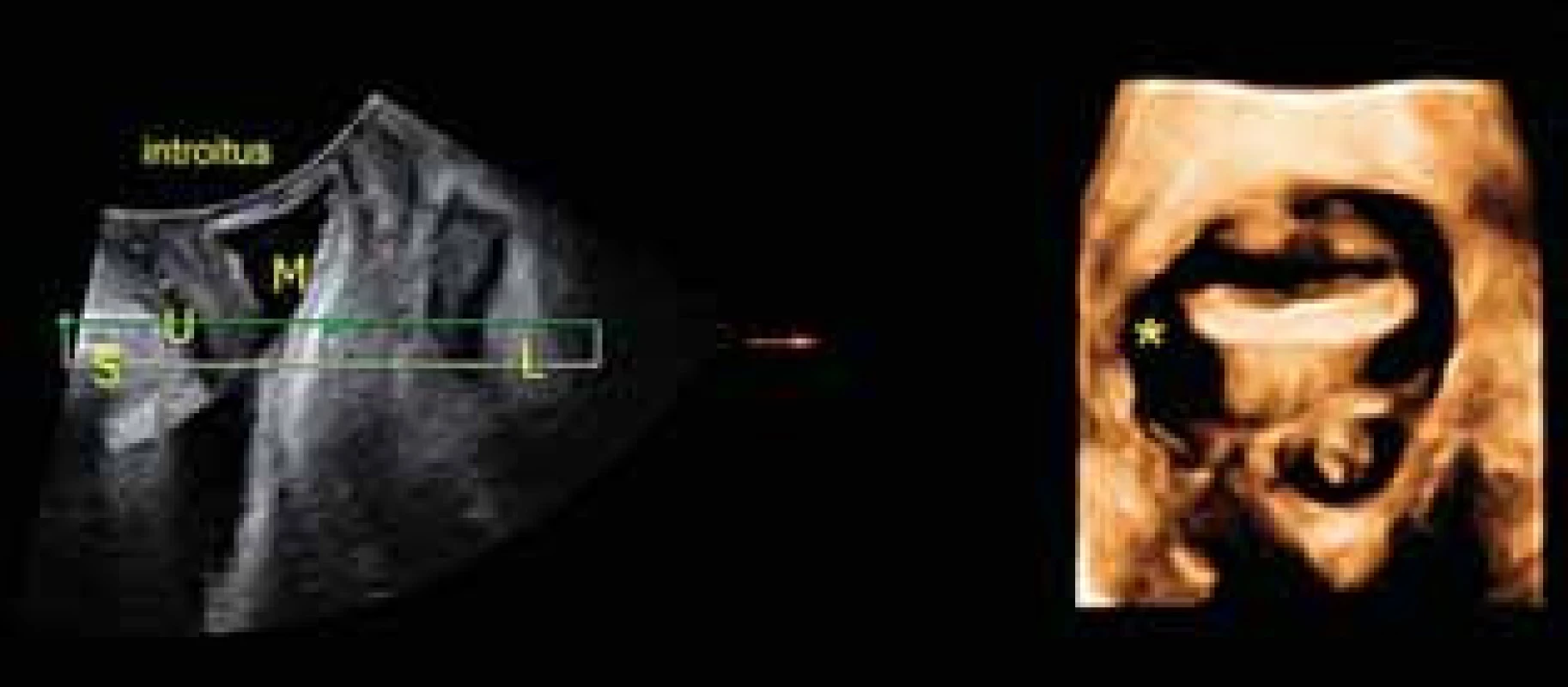 4D ultrazvukové vyšetření prolapsu: Levá část: Sagitální řez S – symfýza, L – levator, U – uretra, M měchýř. Pravá část: axiální řez levatorového hiatu s pravostrannou avulzí levatoru označena hvezdičkou