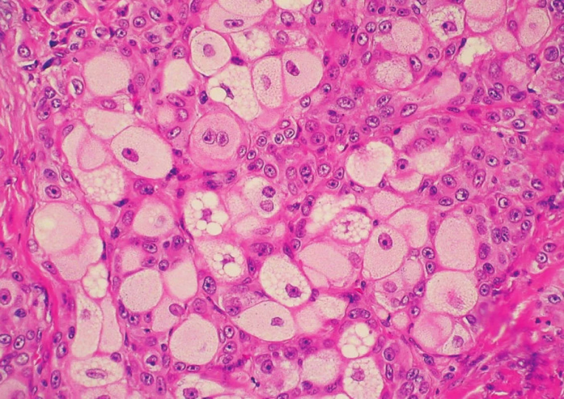 Patognomonickým projevem sebaceózní diferenciace nádorových buněk byla jemně granulovaná eozinofilní až světlá, místy typicky drobně vakuolizovaná cytoplazma s jadernými impresemi (HE, 400x)