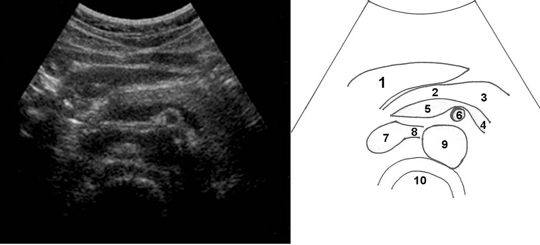 Příčný řez středním epigastriem; 1 – levý lalok jater, 2 – tělo pankreatu, 3 – kauda pankreatu, 4 – vena lienalis, která se mediálně spojuje s vena epigastrica superior ve 5 – vena portae, 6 – příčně zachycená a. mesenterica superior, 7 – vena cava inferior a do ní vstupující 8 – vena renalis l. sin. přebíhající aortu (zde její průběh nad aortou komprimován), 9 – aorta, 10 – tělo obratle (pravděpodobně L1)