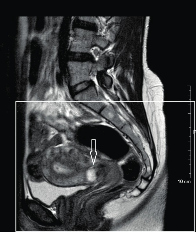 MRI malé pánve – sagitální řez