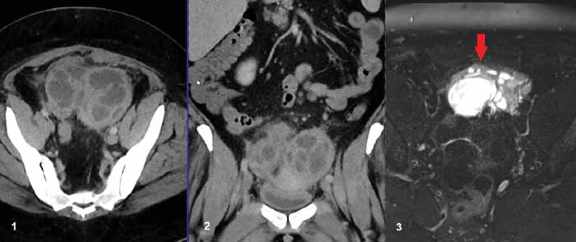 42letá pacientka s bolestmi břicha a zánětlivou laboratoří, se známými polycystickými ovarii fi xovanými pod přední stěnou břišní (červená šipka), jak je patrné na obrázku C, kde je MR nález 15 měsíců před CT vyšetřením v T2 vážení s potlačením signálu tuku. Na obr. A a B jsou v CT obraze patrna polycystická ovaria s nízkou denzitou obsahu, tedy byla zvažována přítomnost prostých cyst. Na peroperačním preparátu byly prokázány kolekce hnisu a byla provedena oboustranná adnexektomie. 