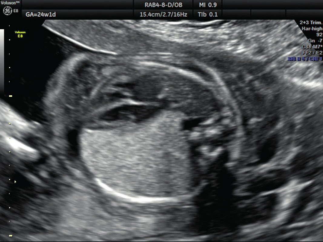 Ultrazvukové vyšetření ve 24. týdnu těhotenství – bronchopulmonální sekvestrace
Přetrvávající nález bronchopulmonálního sekvestru, je přítomna dextrokardie, hydrotorax ani povšechný hydrosp plodu není přítomen.