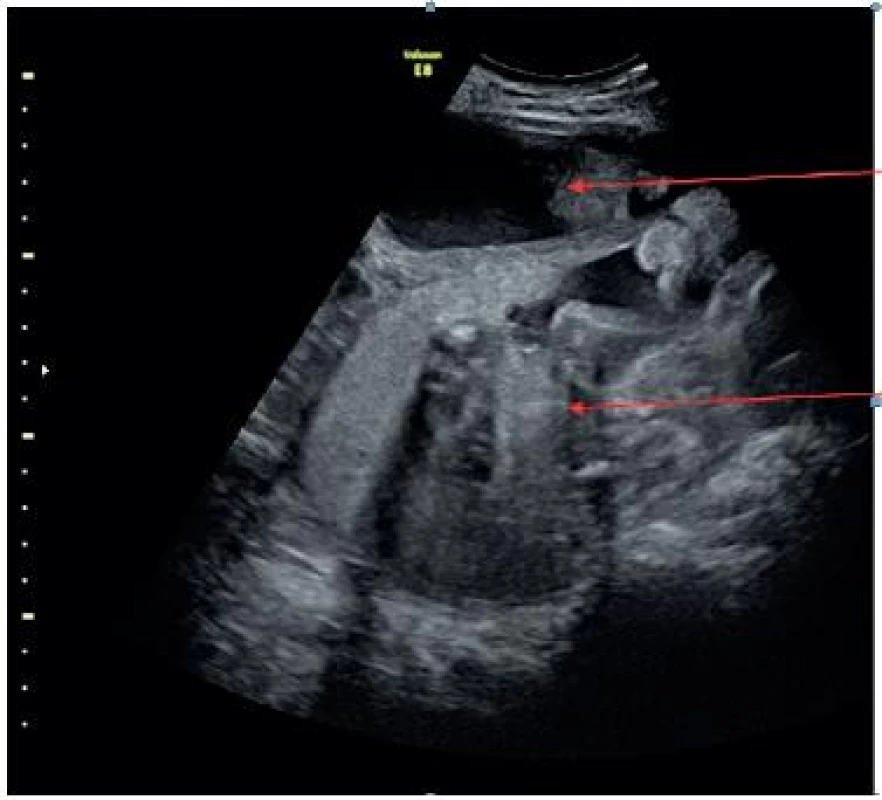 Ultrazvukové vyšetření abdominální sondou, šipkami označen přední a zadní kompartment, mezi nimi děložní pseudoseptem vzniklé překlopením děložního fundu do Douglasova prostoru