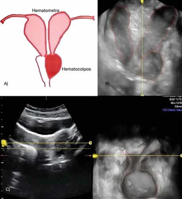Pre-surgery imaging. A) A schematic picture showing uterus didelphys with obstructed left hemihematocolpos represents transabdominal coronal view (B) of uterus didelphys with hematometra (red dotted lines) in combination with blood fi lled left hemivagina (orange dotted line). C) Transabdominal 3D ultrasound virtual contrast imaging of the uterus in coronal view shows left hemicervix communicating with dilated left blind ending hemivagina (yellow dotted line).