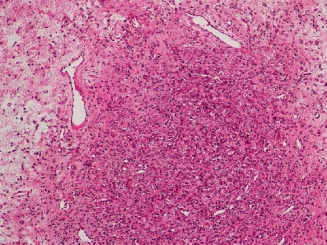 Pseudolobulární uspořádaní nádoru, buněčné pseudolobuly jsou odděleny hypocelulárními fibrózními nebo edematózními partiemi (hematoxylin eozin, zvětšeno 100x)