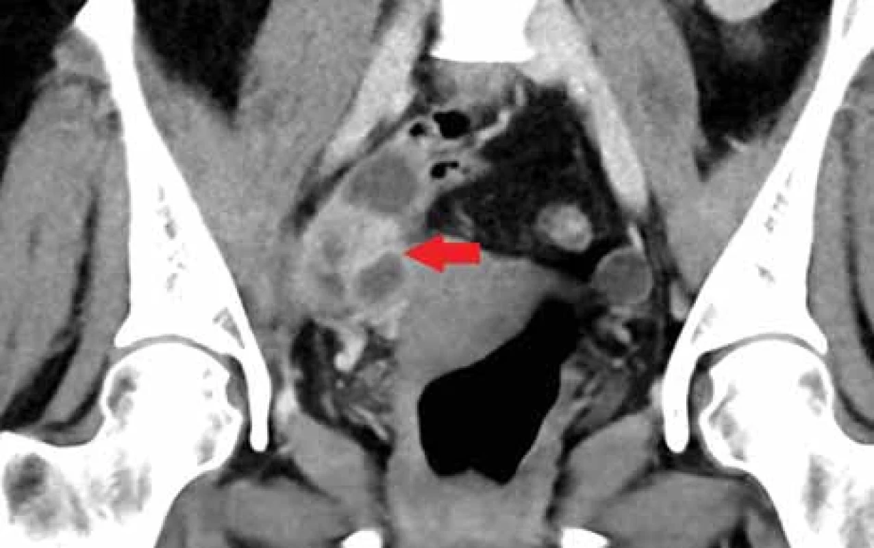 Typický CT obraz tuboovariálního (TOA) abscesu, kolekce tekutiny v ovariu, které se mírně sytí (červená šipka), nad ovariem je patrná tekutina. 