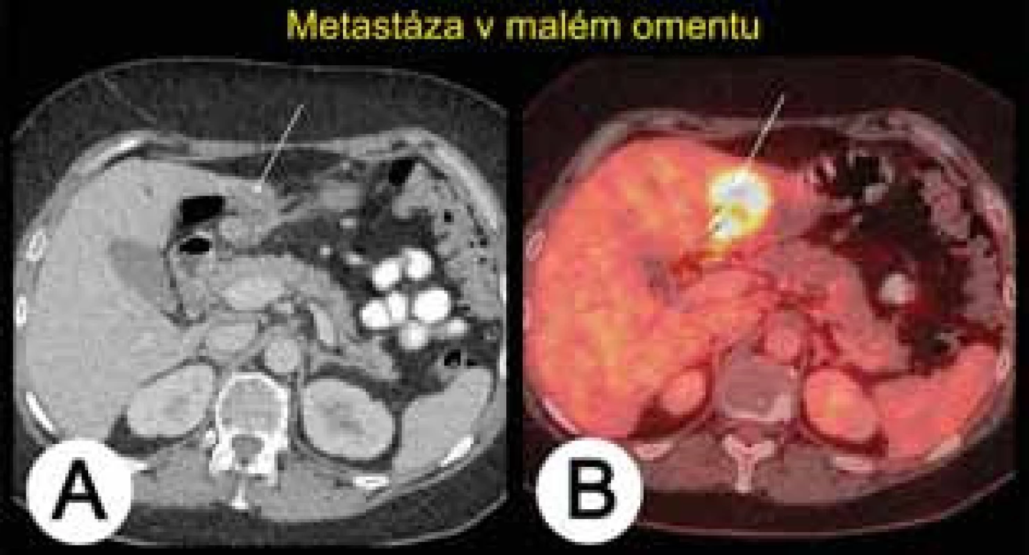 Metastáza karcinomu ovaria v oblasti omentum minus při kombinovaném vyšetření PET/CT