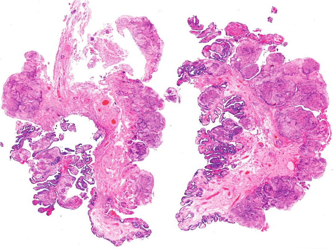 Histopatologie: přehledný snímek polypoidně utvářené sliznice prostoupené epiteloidními granulomy a lymfocytárním infiltrátem.