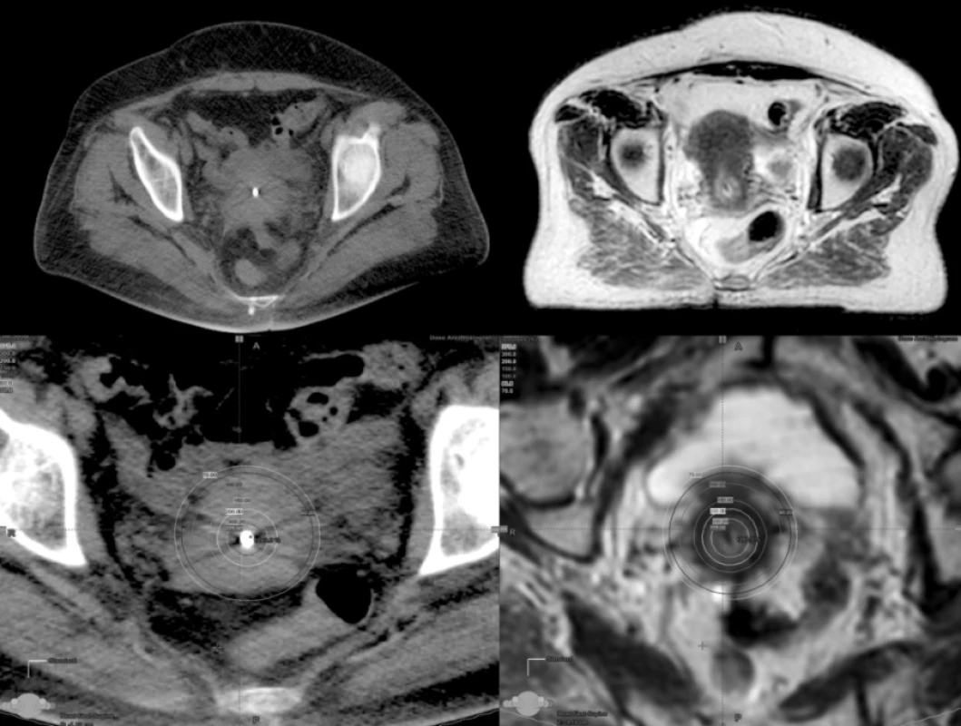 Karcinom děložního hrdla a dávková distribuce při 3D plánování v transverzální rovině na CT a MR