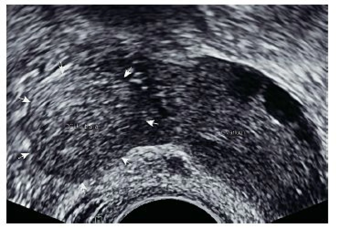V blízkosti pravého ovaria nehomogenní, spíše solidní ohraničená rezistence bez typických struktur plodového vejce – suspektní graviditas extrauterina tubaria l.dx
