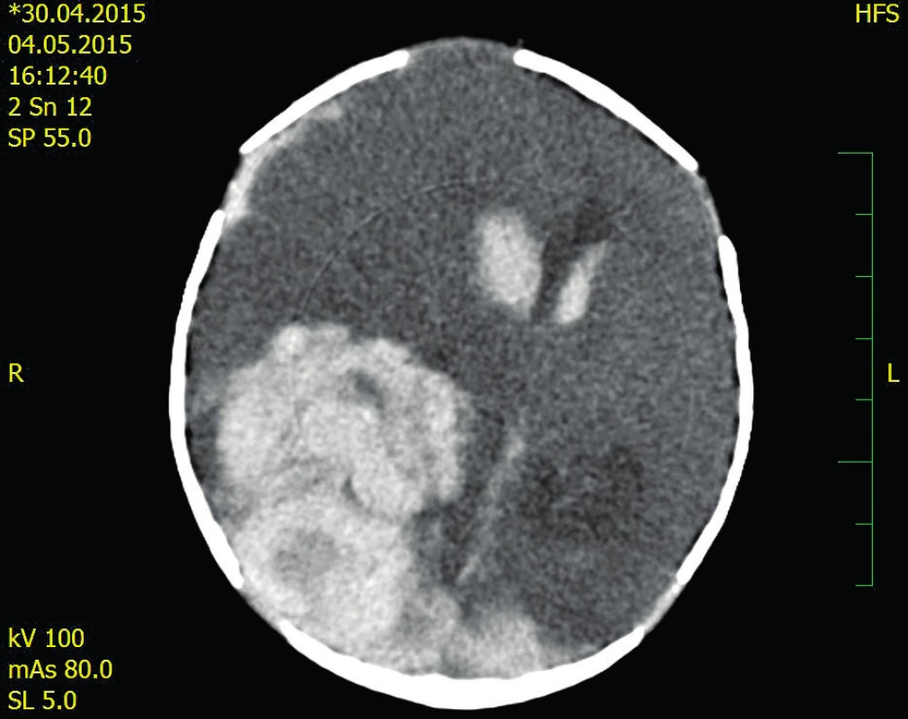 CT neurokrania