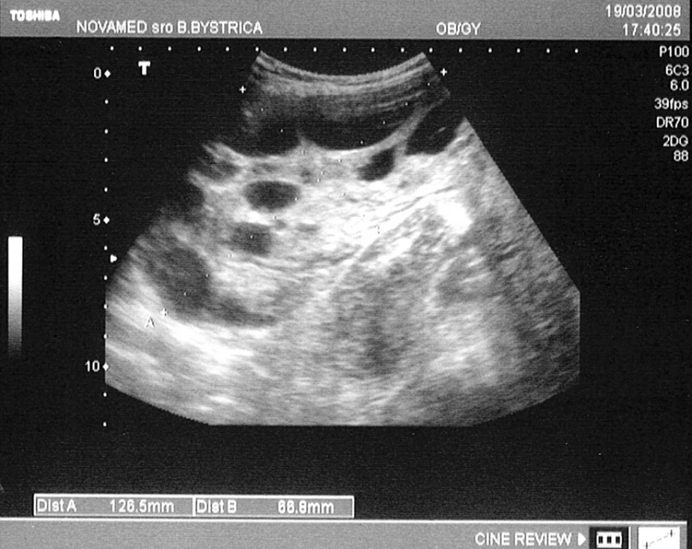 Ultrasonografický nález pravého ovária v 9. GW v druhej gravidite