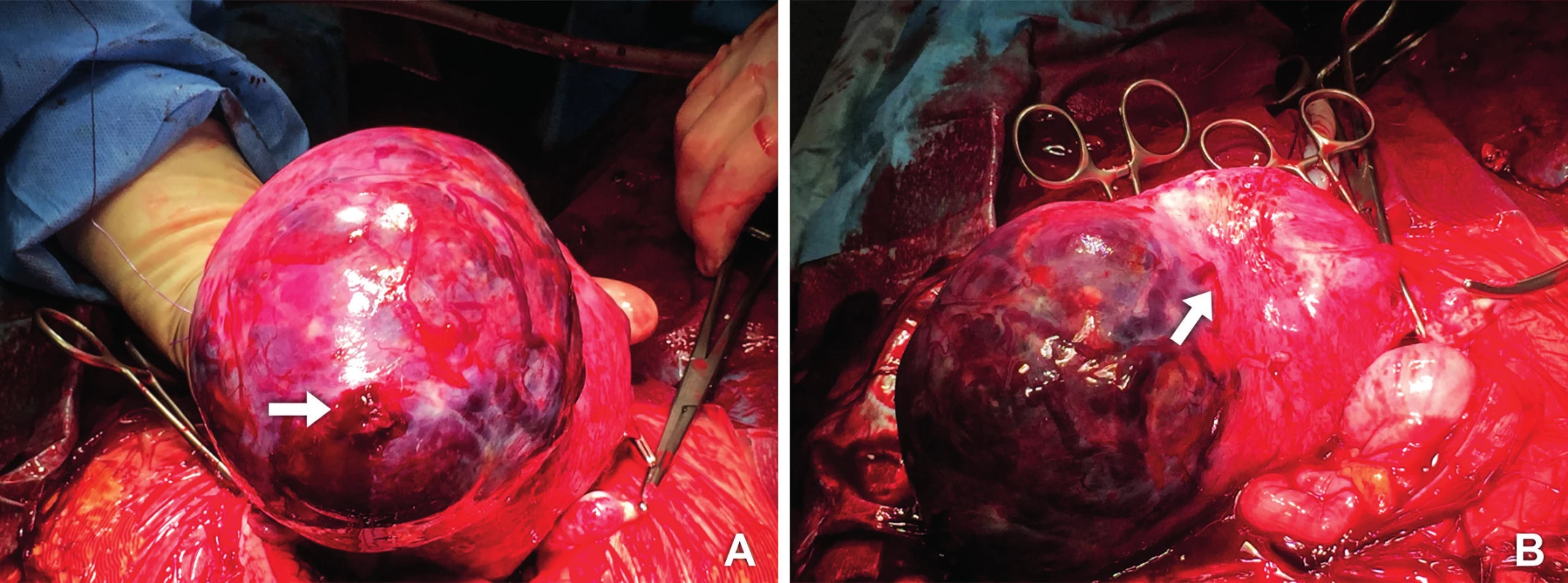 Operační nález
A. Placenta percreta prorůstající z levého děložního rohu (šipka ukazuje zdroj krvácení)
B. Plošně adherující placenta, která na několika místech prorůstá děložní stěnou