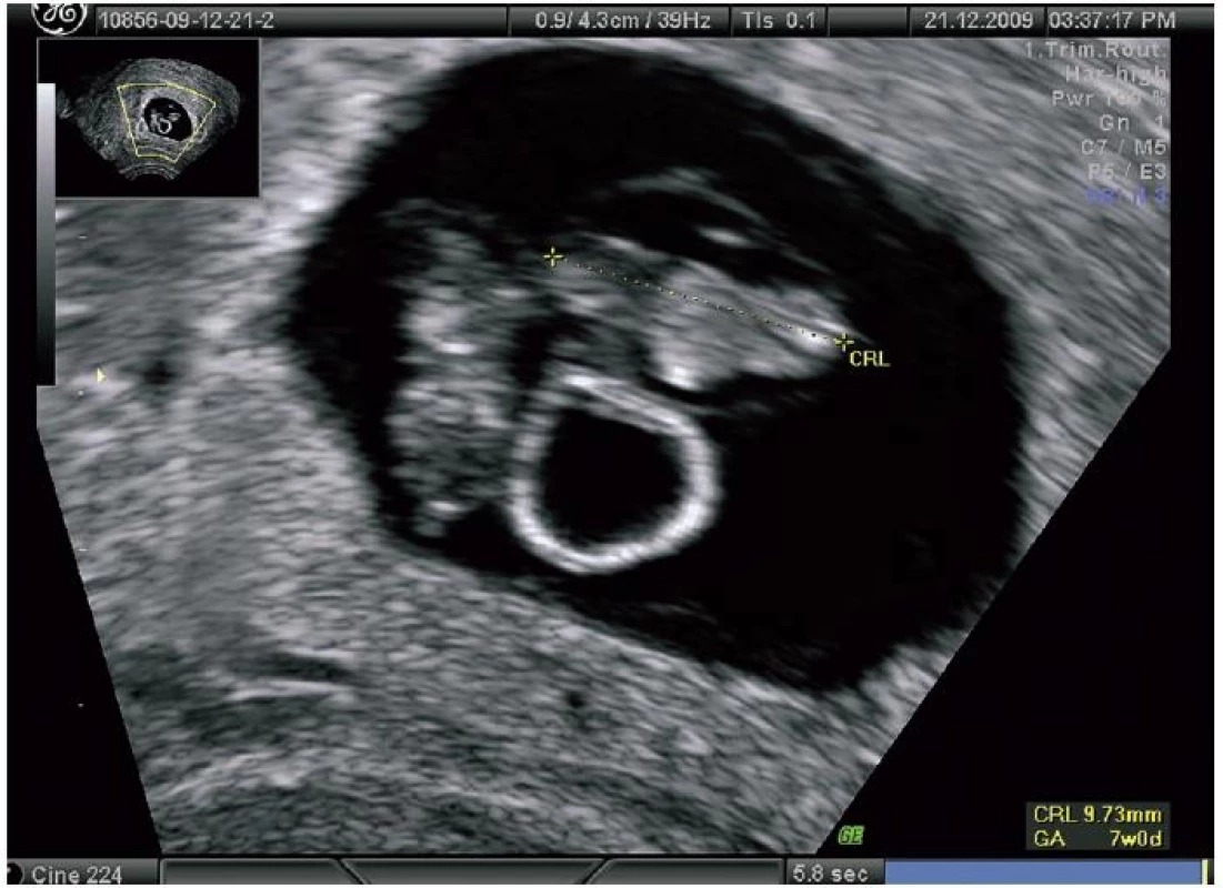Monochoriální biamniální gemini se společným žloutkovým váčkem v 7. týdnu těhotenství