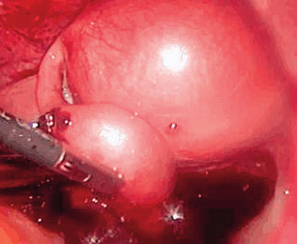 Ektopická gravidita v levé tubě