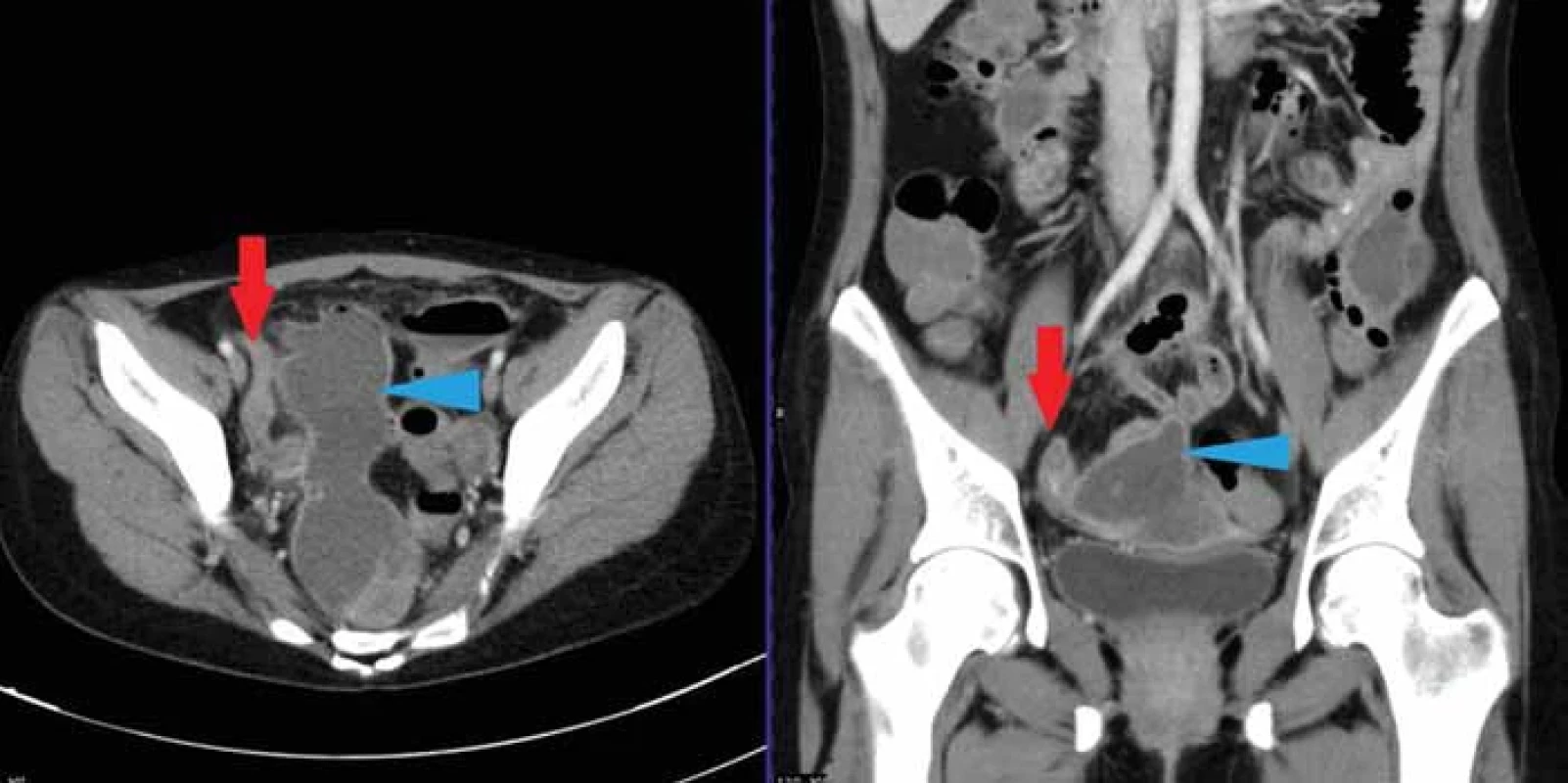 32letá pacientka se známou Crohnovou nemocí, přichází s bolestí v podbříšku. Na CT je patrna objemná KT v pánvi (modrá šipka), která byla obklopena tenkými kličkami, na nichž byly přítomny skip léze typické pro idiopatický střevní zánět (červená šipka).