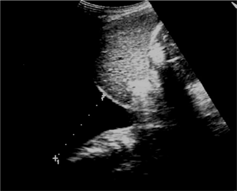 Pohled do pravé pohrudniční dutiny, kde je měřeno depo volné tekutiny (fluidothorax)