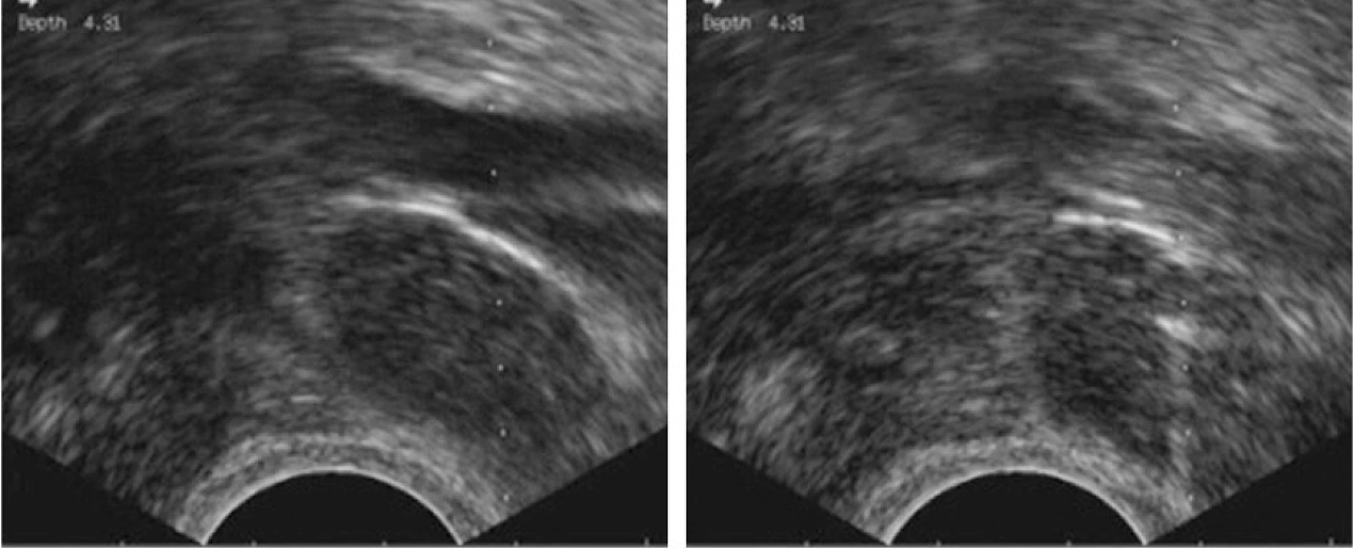 Tru-cut biopsie infiltrované uzliny v obturatorní fosse při externích ilických cévách, vaginální přístup. Ultrazvuková kontrola umožňuje přesnou vizualizaci hrotu jehly (vpravo) a bezpečné provedení výkonu.