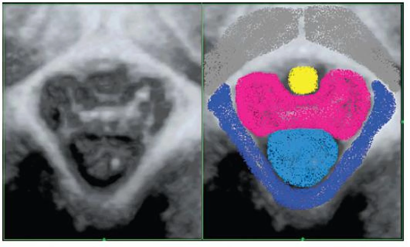 Prostorový model urogenitálního hiátu. Vlevo: 3D UZ distální porce levátoru, která se podílí na tvorbě ohraničení urogenitálního hiátu. Vpravo: Barevně jsou zvýrazněny jednotlivé anatomické jednotky. Orgány procházející hiátem: uretra (žlutá), pochva, která má motýlovitý tvar (růžová), rektum (světle modrá), distální okraj spony (šedivá), distální porce levátoru – m. pubococcygeus (tmavě modrá). (Z materiálu ÚPMD)