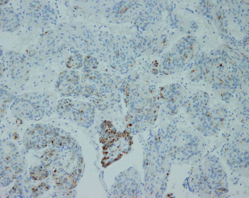 Mikroskopické vyšetrenie nádorových buniek s pozitivitou na HMB-45 (human melanoma black-45, zväčšené 200×).