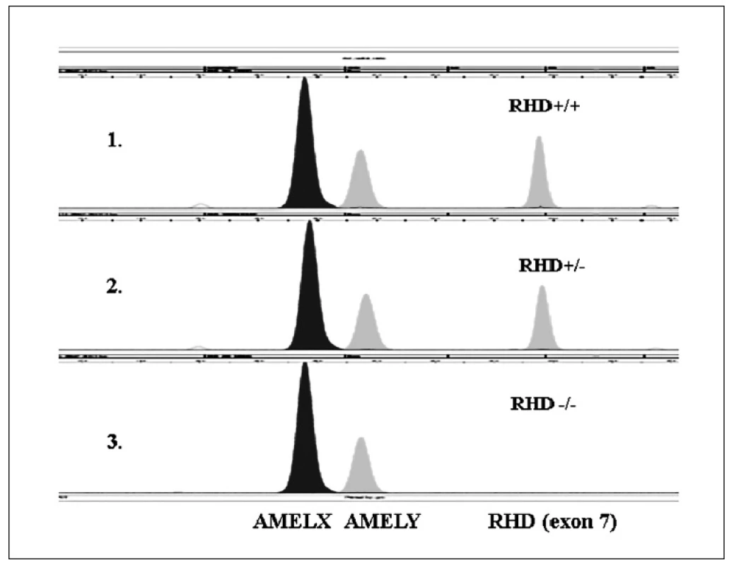 Ukázka rozlišení &lt;i&gt;RHD&lt;/i&gt;  genotypů pomocí minisekvenace (SNaPshot).
1. V první řadě je ukázka &lt;i&gt;RHD&lt;/i&gt; pozitivního homozygota. 2. V druhé řadě je ukázka &lt;i&gt;RHD&lt;/i&gt; heterozygota. 3. Ve třetí řadě je ukázka &lt;i&gt;RHD&lt;/i&gt; negativního homozygota.