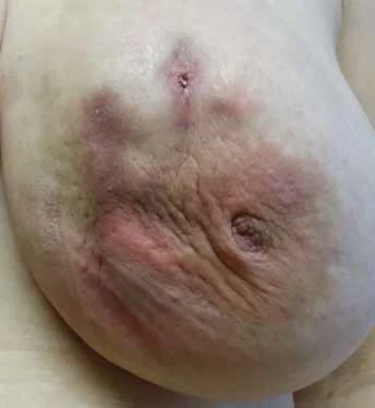 36-year-old patient with idiopathic granulomatous mastitis after repeated antibiotic treatment and surgical intervention, before the initiation of anti-inflammatory therapy.