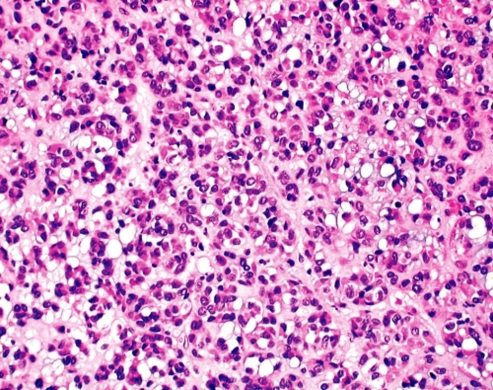 GIST. Rozsáhlá ložiska epiteloidní přeměny nádorových elementů s tvorbou pruhů a hnízd. Patrná je výrazná intracelulární vakuolizace a myxoidní prosak mezibuněčné hmoty – obraz věrně napodobující epitelový tumor (HE, 200x)