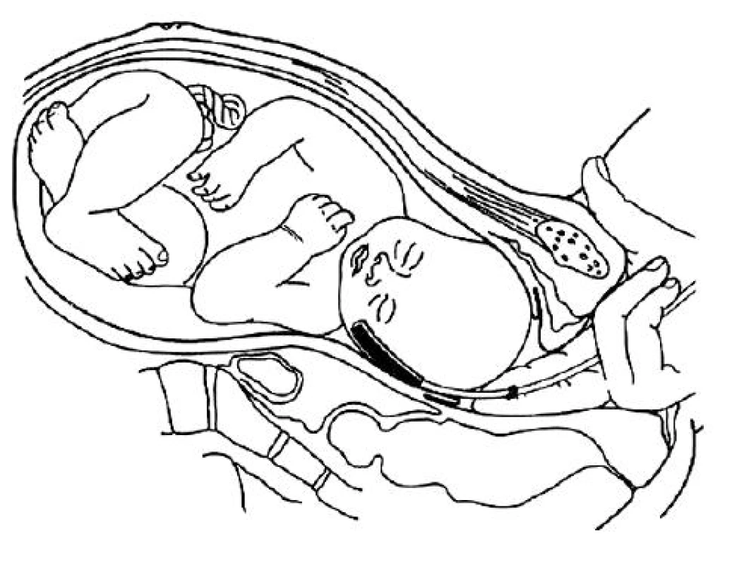 Technika transcervikálneho zavedenia fetálneho snímača oxymetra, typ FS–14 [8]