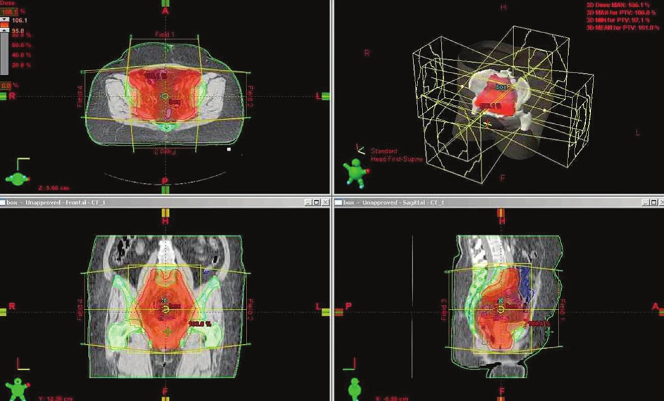 Radioterapie pánve 3D-konformní BOX technikou
