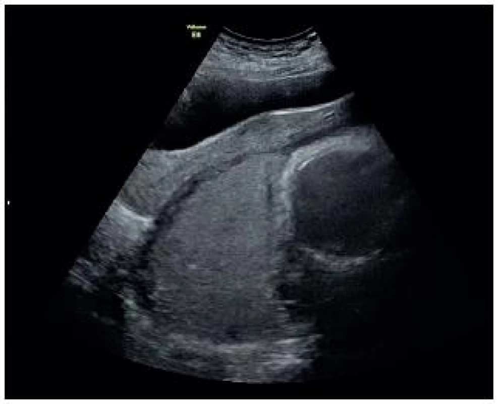 Ultrazvukové vyšetření abdominální ondou, shora patrný vytažený močový měchýř, elongované děložní hrdlo, placenta v děložním fundu a hlavička plodu