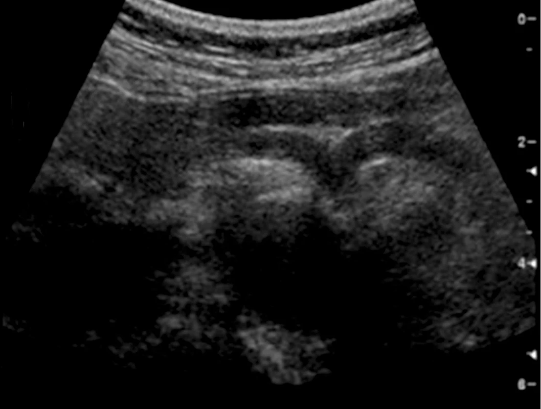 Zobrazení větvení truncus coeliacus (tzv. obraz velrybí ploutve nebo obraz racka), a. hepatica communis a a. splenica (třetí odstupující céva, a. gastrica sinistra, která má menší kalibr, se v tomto řezu zpravidla nezobrazuje)