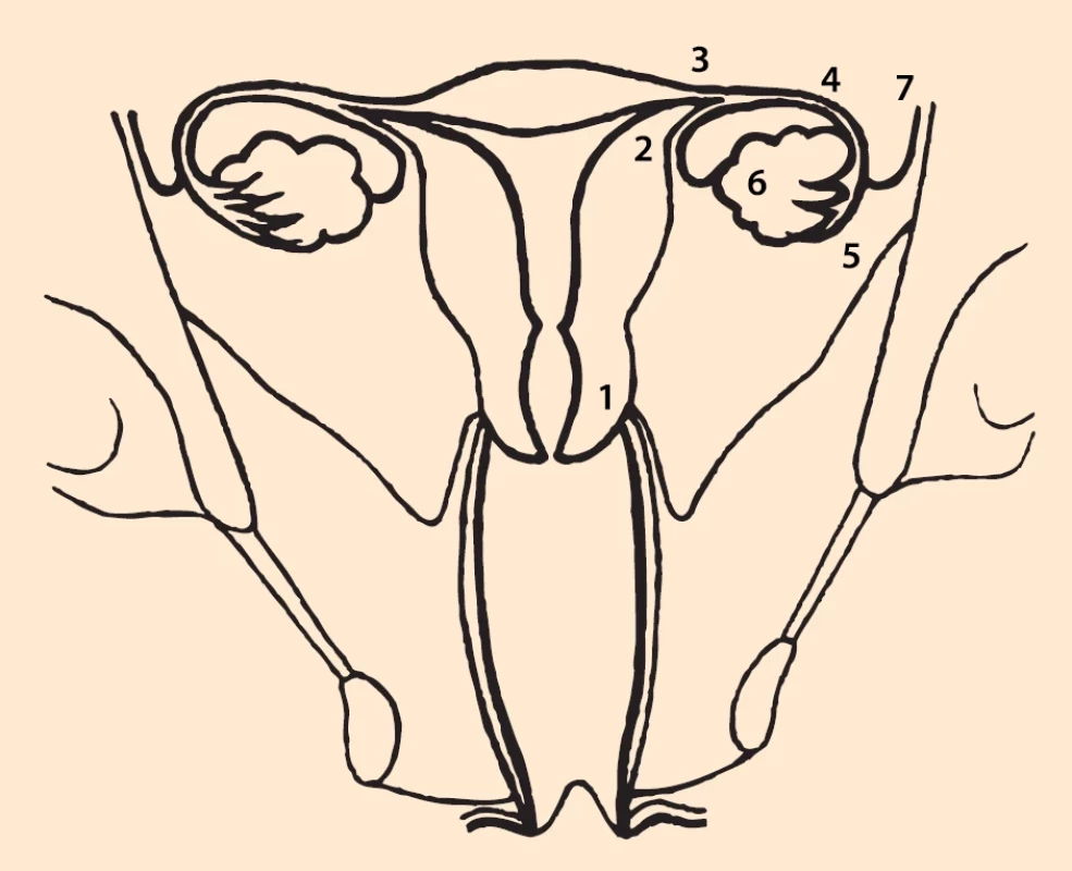 Možné lokalizace mimoděložního těhotenství [1]. </br>1. cervikální, 2. intersticiální, 3. istmická, 4. tubární, 5. ampulární, 6. ovariální, 7. abdominální.