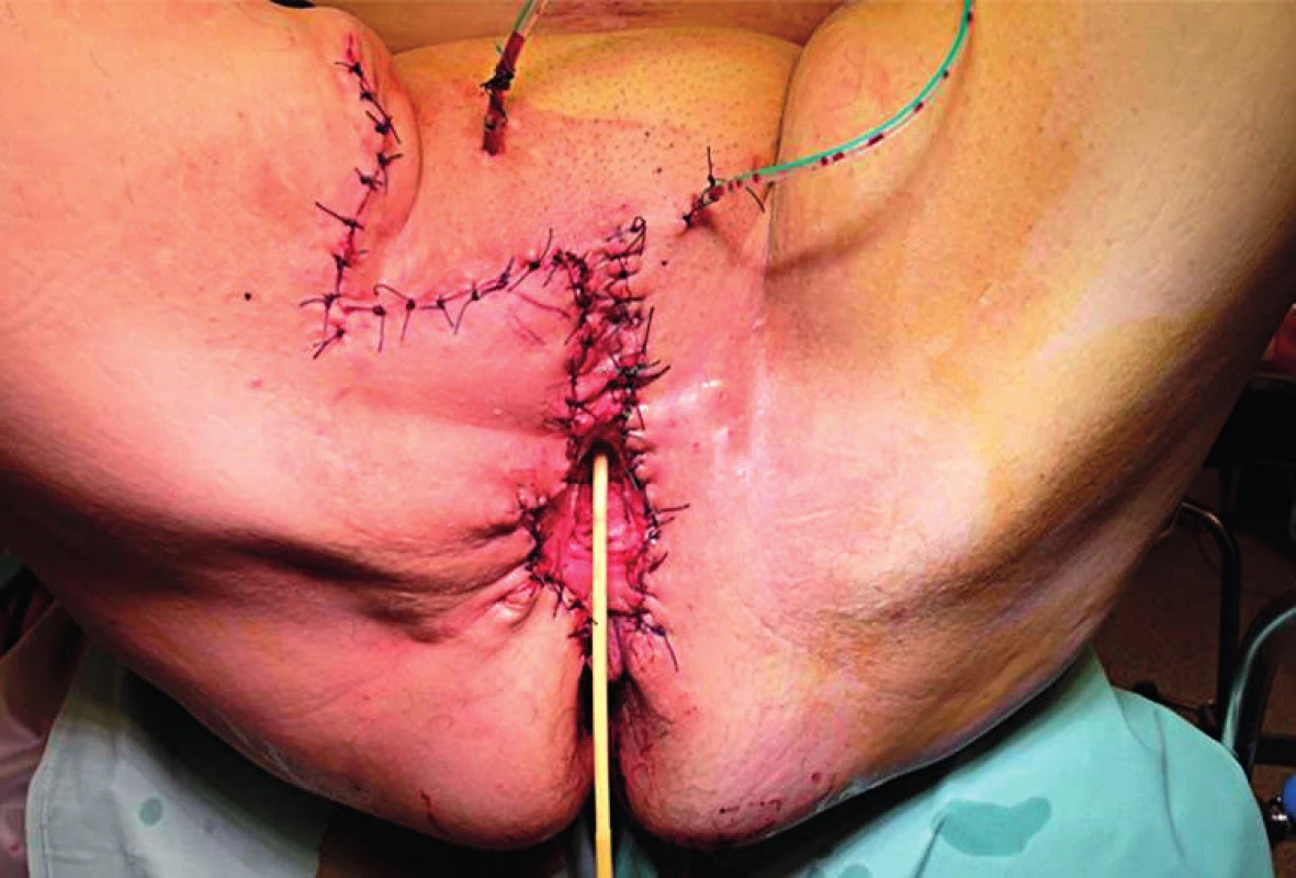 Konečný stav po sutuře vzniklého defektu (po uvolnění a posunu kožního laloku vpravo)
