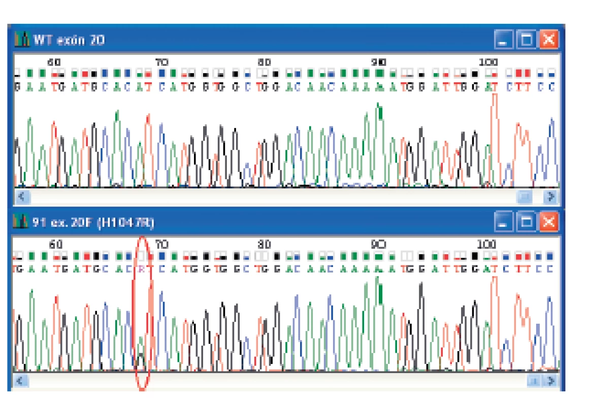 Elektroferogramy zobrazujúce wild-type sekvenciu a „hotspot“ mutáciu v exóne 20 PIK3CA génu. Na obrázku sú uvedené čísla vzoriek a typ mutácie. Miesto mutácie je vyznačené.