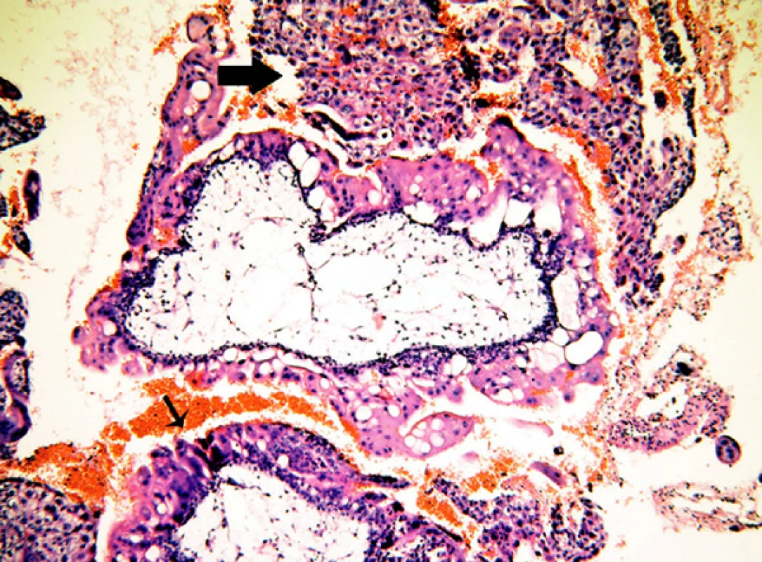 Mola proliferans: těžká hyperplazie vilózního trofoblastu pokrývající celý obvod klků (malá šipka). Objemná ložiska intervilózního trofoblastu (velká šipka), atypie