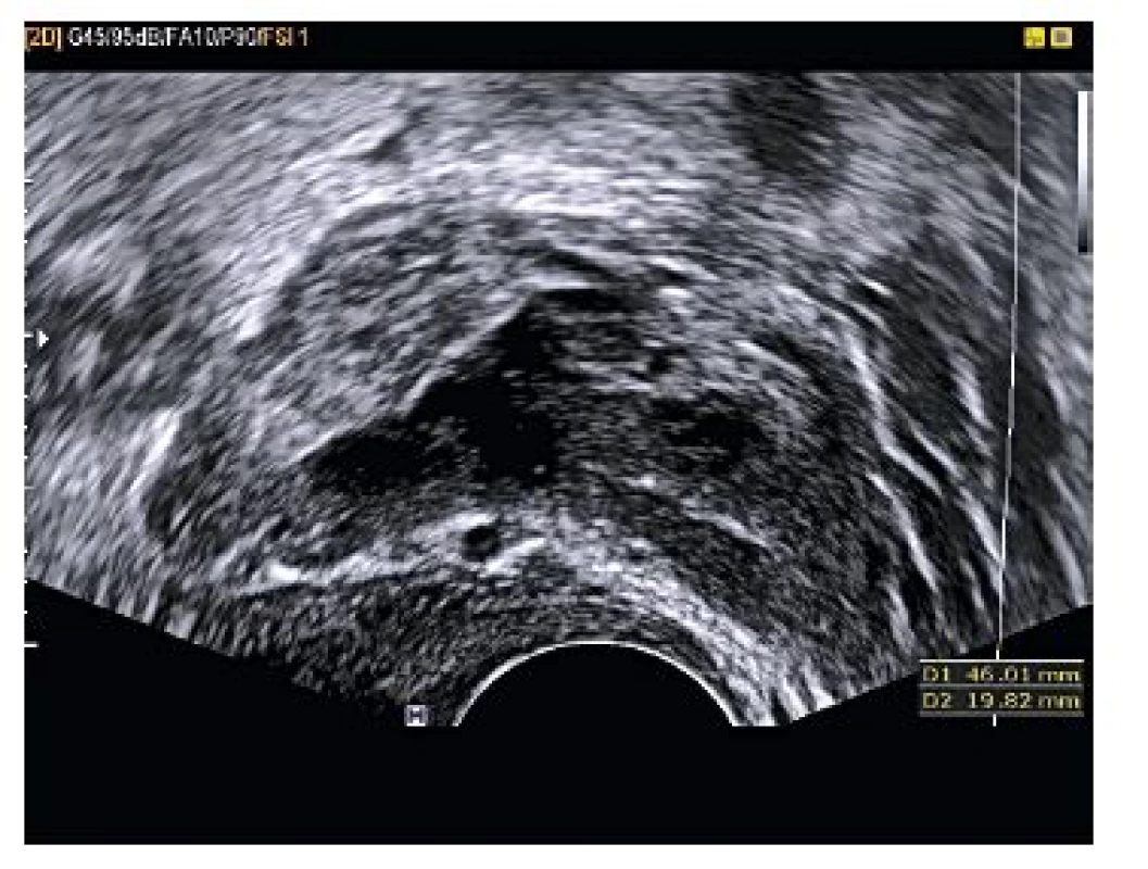 V blízkosti levého ovaria protáhlá nehomogenní masa (blob sign), rozměrů 46,01×19,82 mm, která nejeví souhyb s ovariem – ektopická gravidita l. sin.