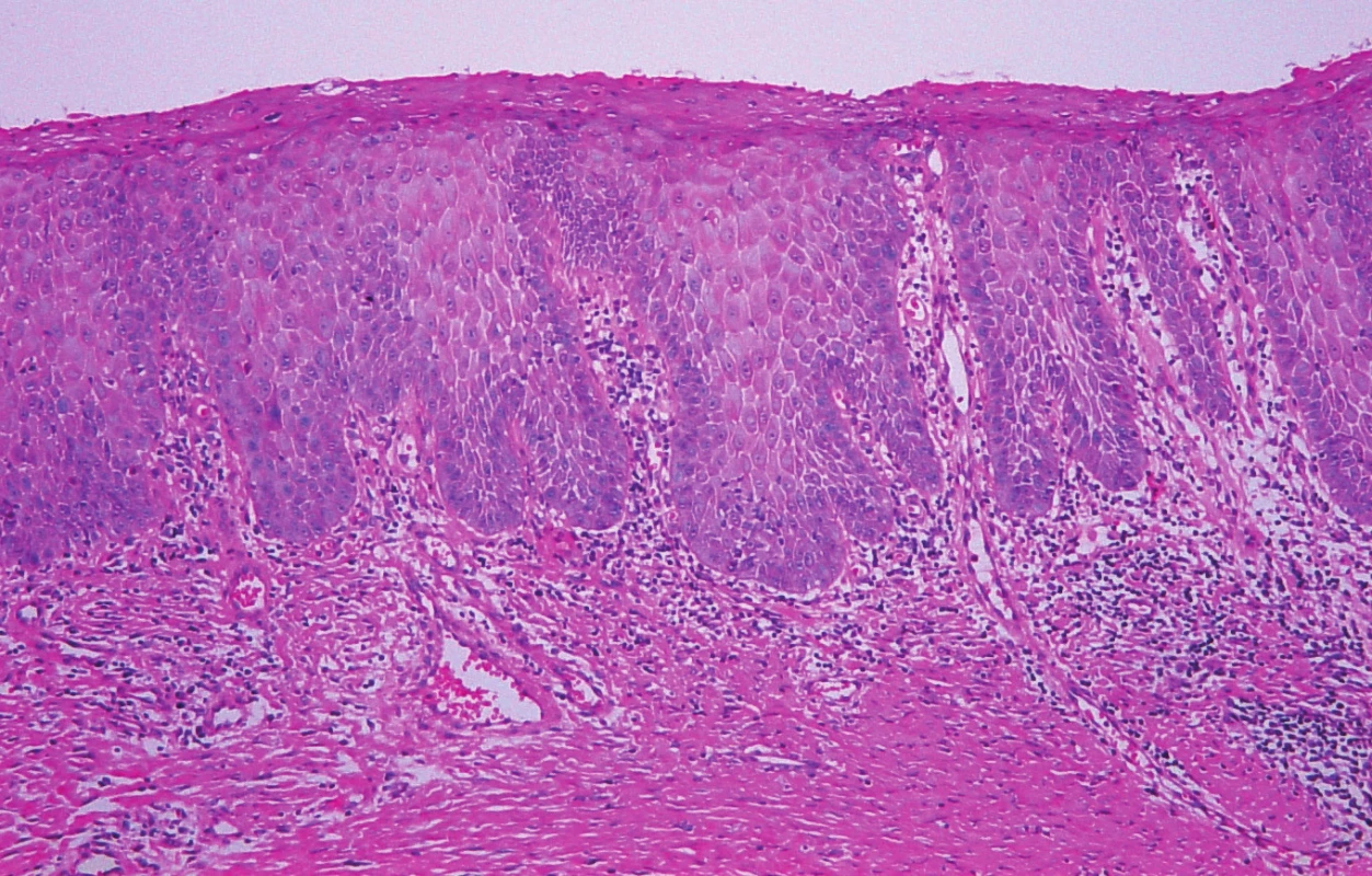Histologický obraz DVIN (barvení hematoxylin-eozin, zvětšení 100)