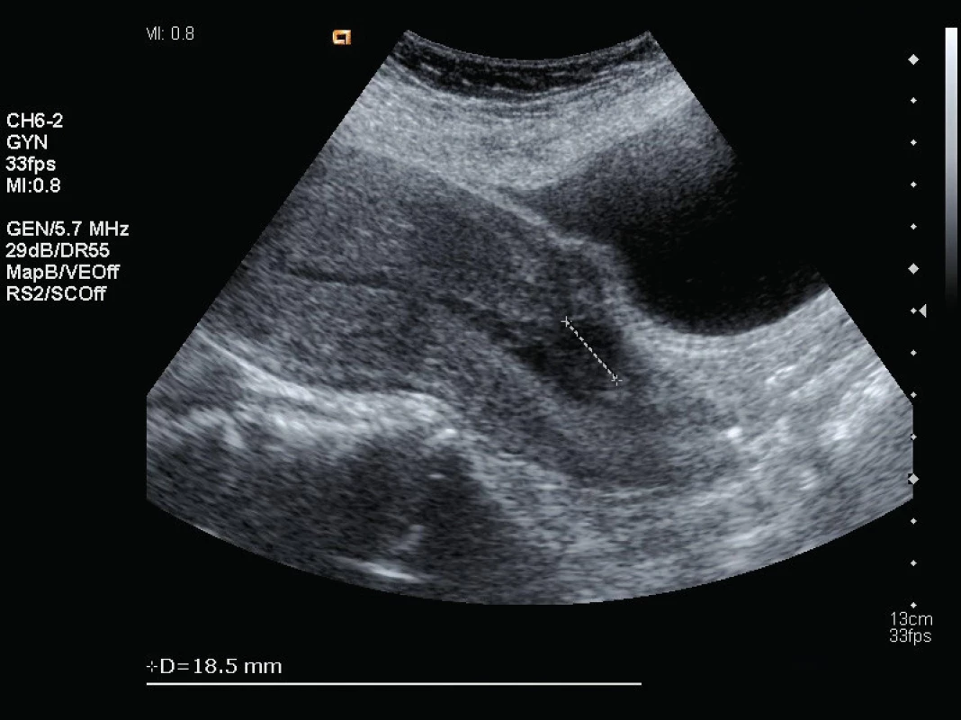 Ultrazvukový nález 11. den po porodu