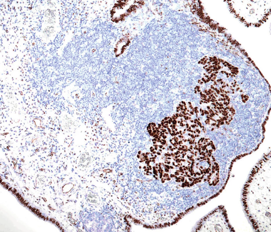 Difuzní jaderné exprese markeru WT-1 v nádorových buňkách. Nenádorový tubární epitel je také pozitivní (původní zvětšení 100×)